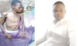 肾癌把我变成了一个骷髅非统组织毕业生