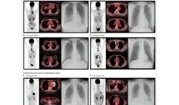 一种新方法可识别有患结核病风险的人群