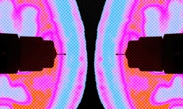 类似奥赛匹克的减肥药可以预防老年痴呆症