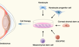 圆锥角膜治疗的新曙光：角膜基质再生的潜在策略